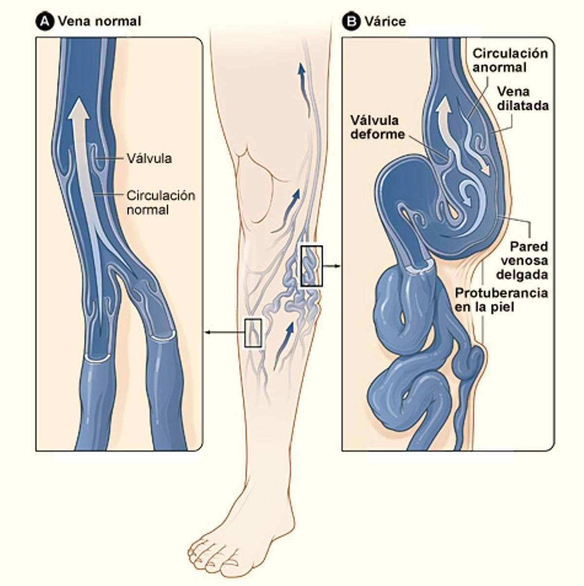 Varicose veins sp