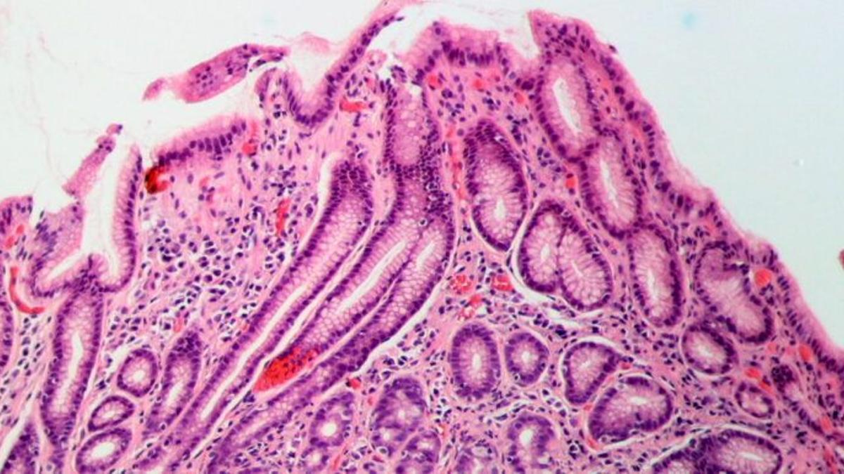 Así puedes saber si tienes helicobacter pylori, una bacteria que afecta a la mitad de la población