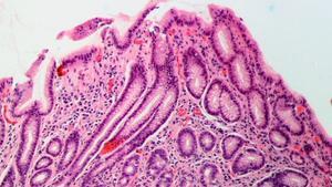 Helicobacter pylori: així són els símptomes de la infecció que afecta la meitat de la població