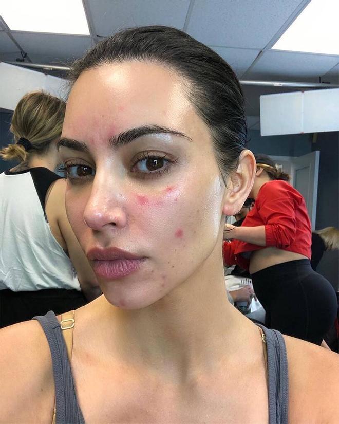 Kim Kardashian revela su psoriasis en sus historias de Instagram. (Instagram: @kimkardashian)