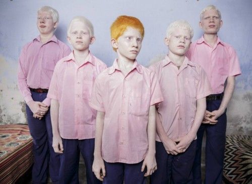 Blind Indian albino boys