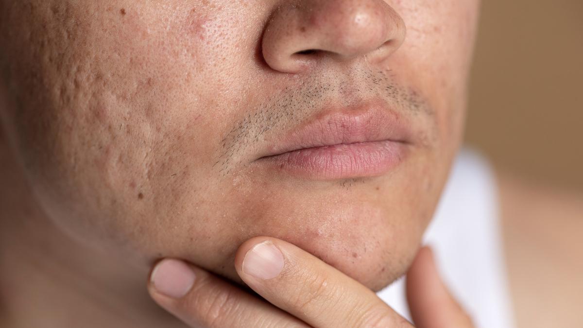 El acné es propio de varones puberales por su relación con los picos de testosterona.
