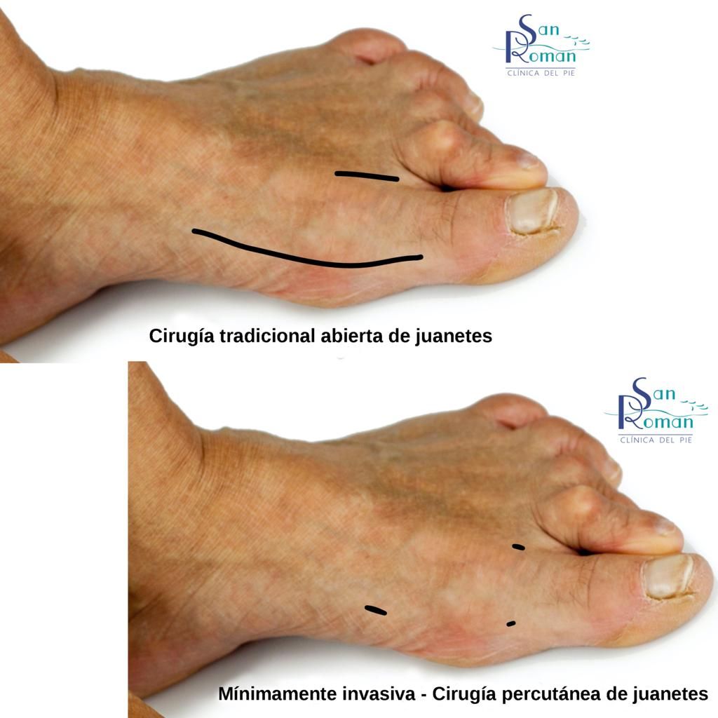 Cirugía tradicional VS Cirugía Mínimamente Invasiva del pie.