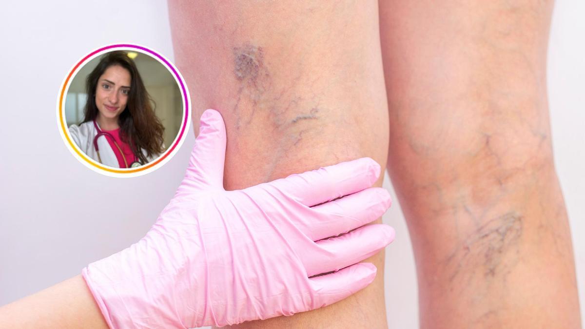 Cómo mejorar las varices; en el círuclo, la doctora Sara Marin.