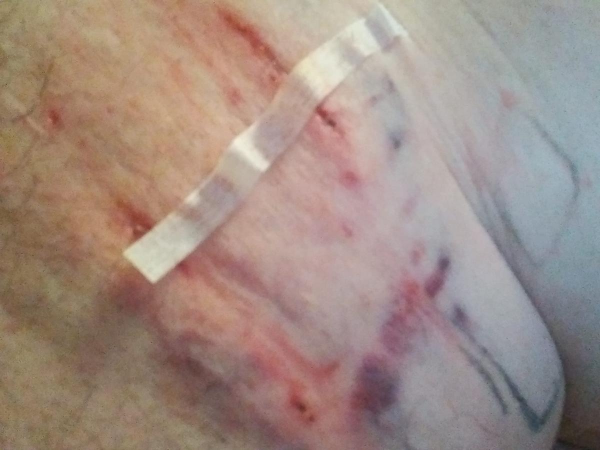 Herida que le provocó la mordedura sufrida.