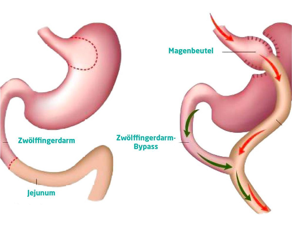 Magenbypass