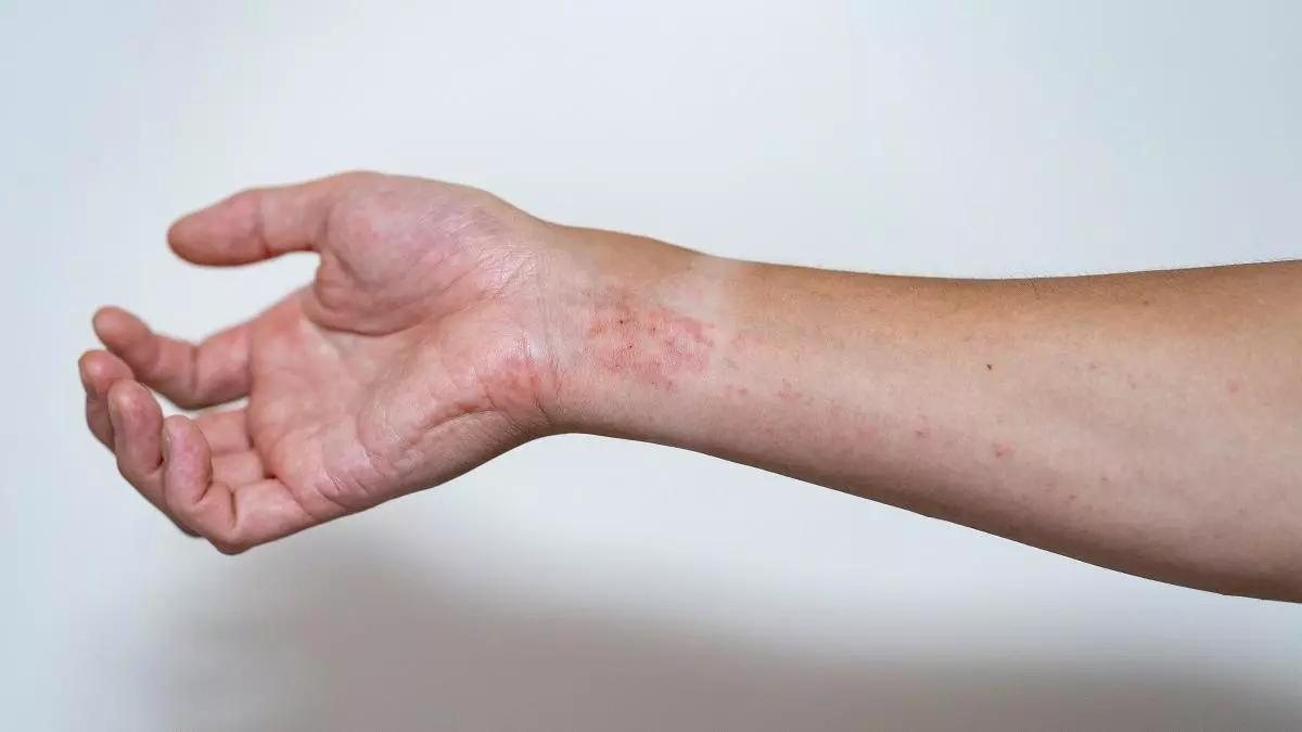 Els símptomes de la dermatitis atòpica poden afectar l'autoestima del pacient