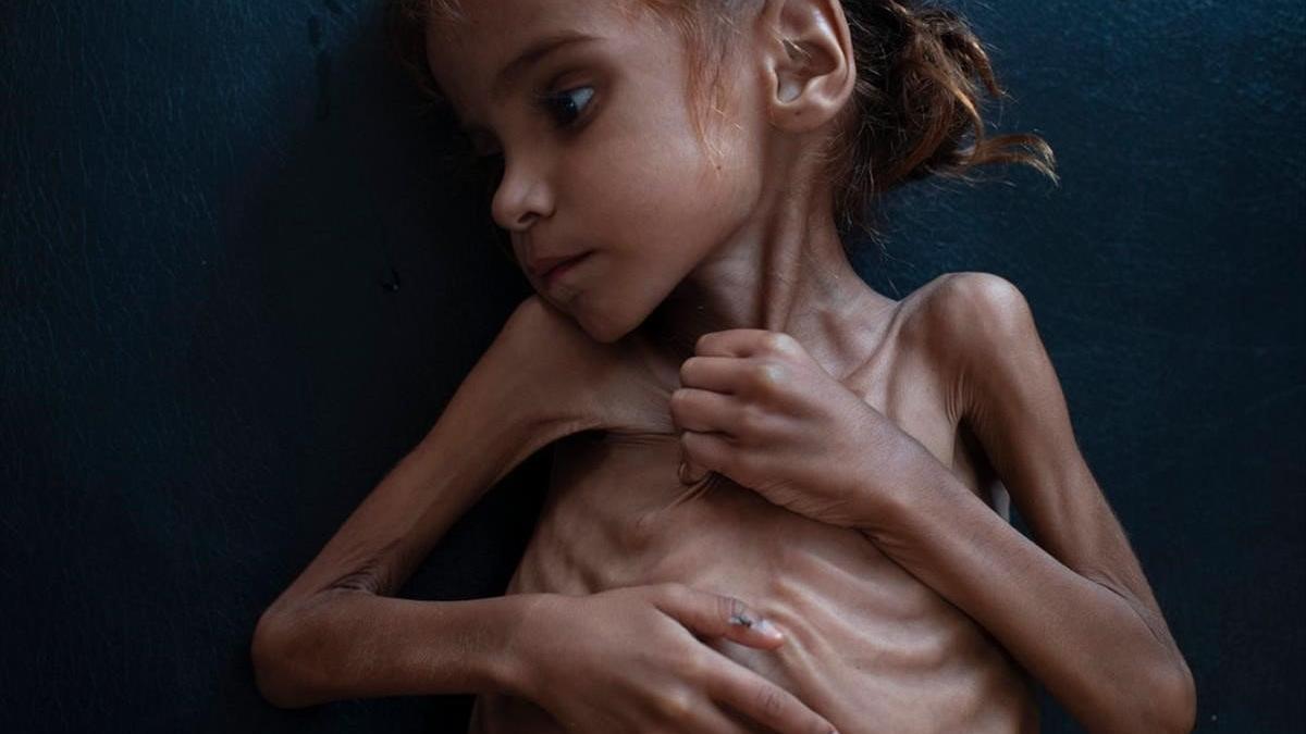 Amal Hussain, la niña yemení de siete años que ha fallecido por desnutrición