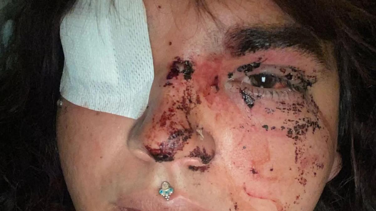 El rostro de Bianca Lilibeth Fernández tras ser agredida en La Bañeza.