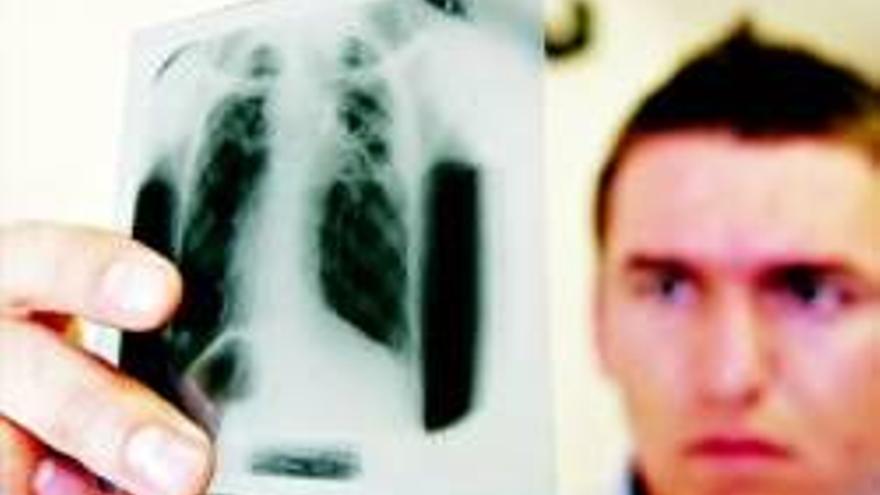 La OMS alerta del avance de la tuberculosis multirresistente