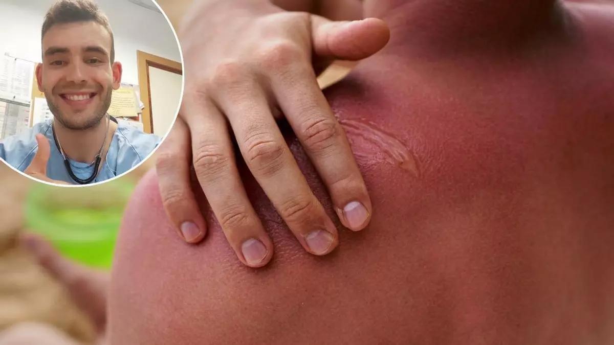 Esto es lo que debes hacer si te has quemado con el sol este verano