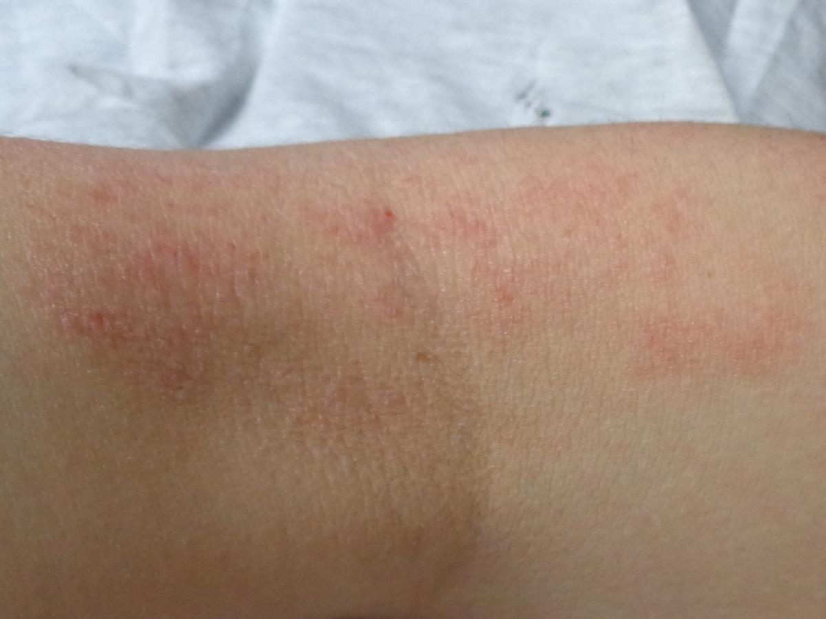 Las huellas de la dermatitis atopica suelen ser muy visibles