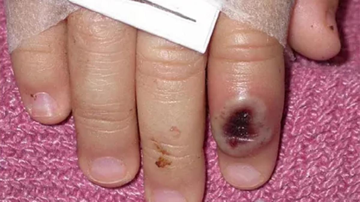 Una persona afectada con la viruela del mono.