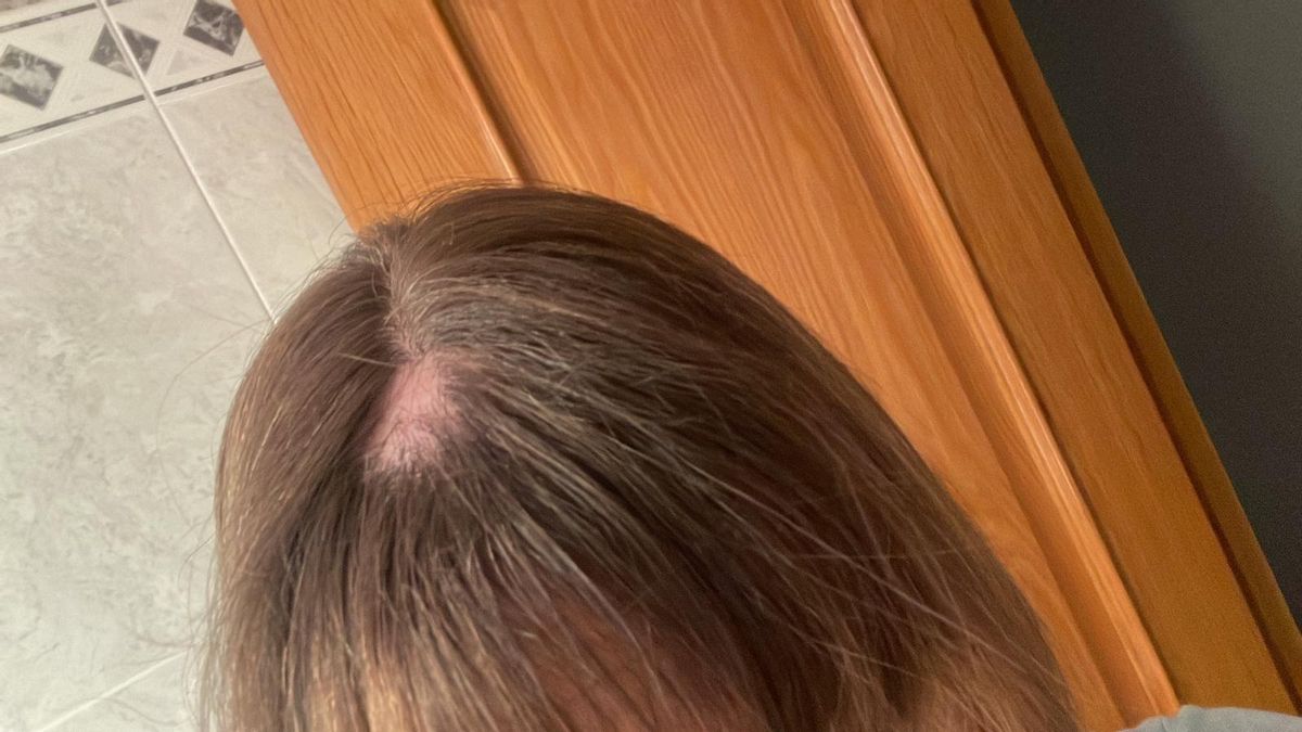 Las lesiones en el cuero cabelludo sufridas por la médica agredida.
