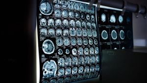 Nova esperança per a la detecció primerenca de l’Alzheimer: la seva relació amb els trastorns intestinals