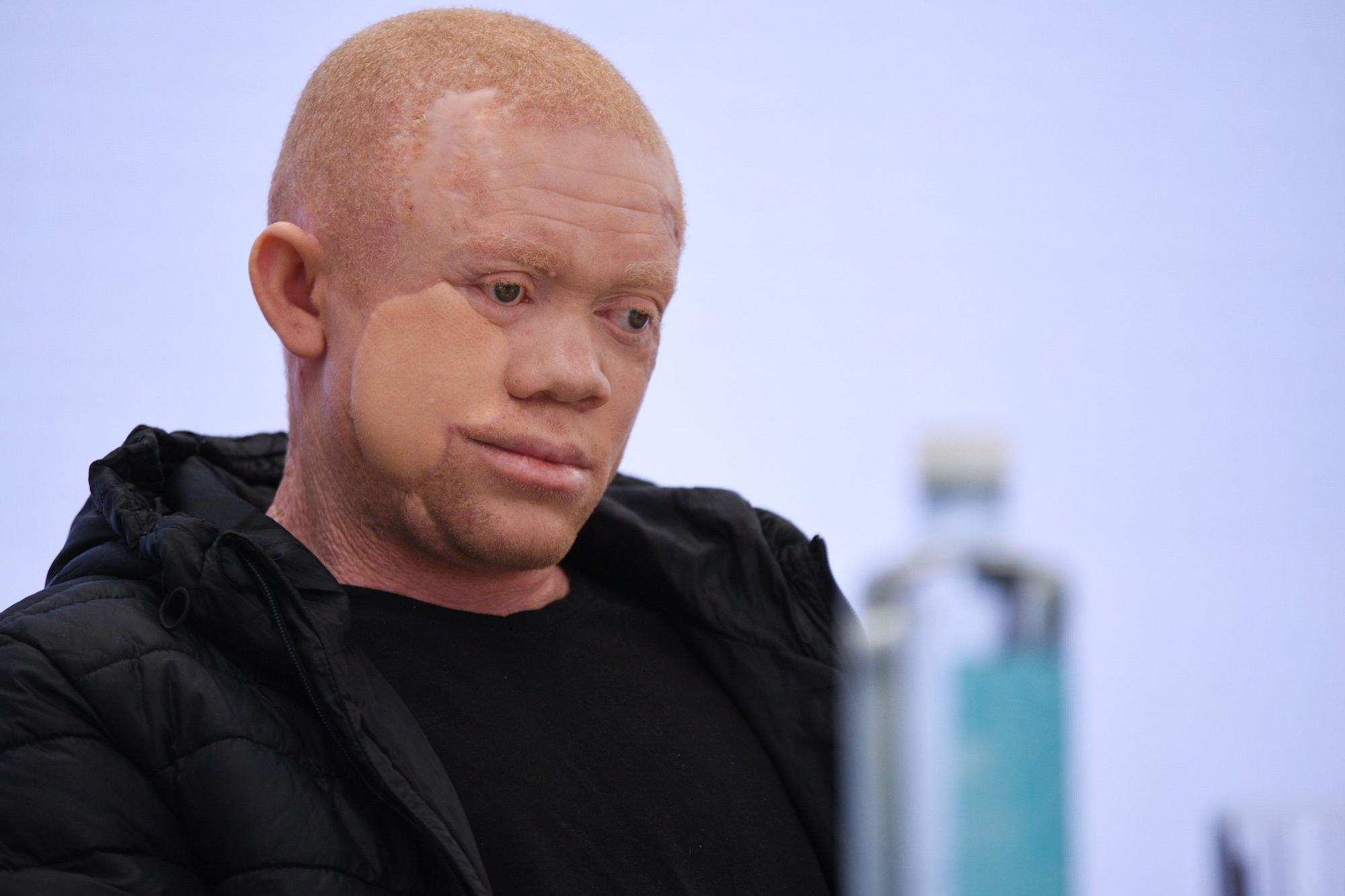 Cavadas reconstruye la cara a un paciente albino