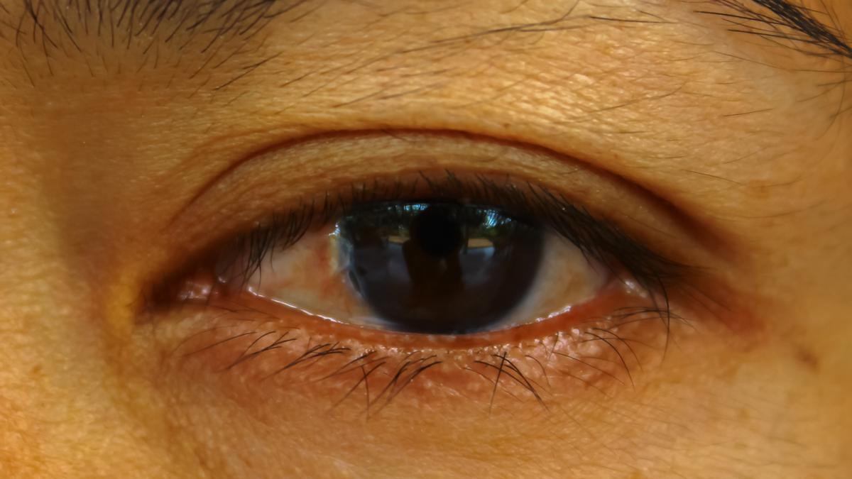 Un ojo con conjuntivitis