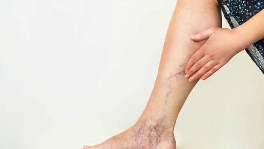¿Qué es la enfermedad venosa crónica? ¿Las varices son solo un problema estético?