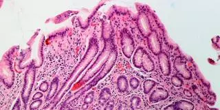 Helicobacter pylori: así son los síntomas de la infección que afecta a la mitad de la población