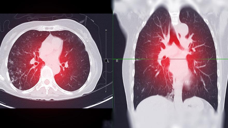 Tromboembolismo pulmonar: qué es, qué síntomas tiene y cómo se puede tratar