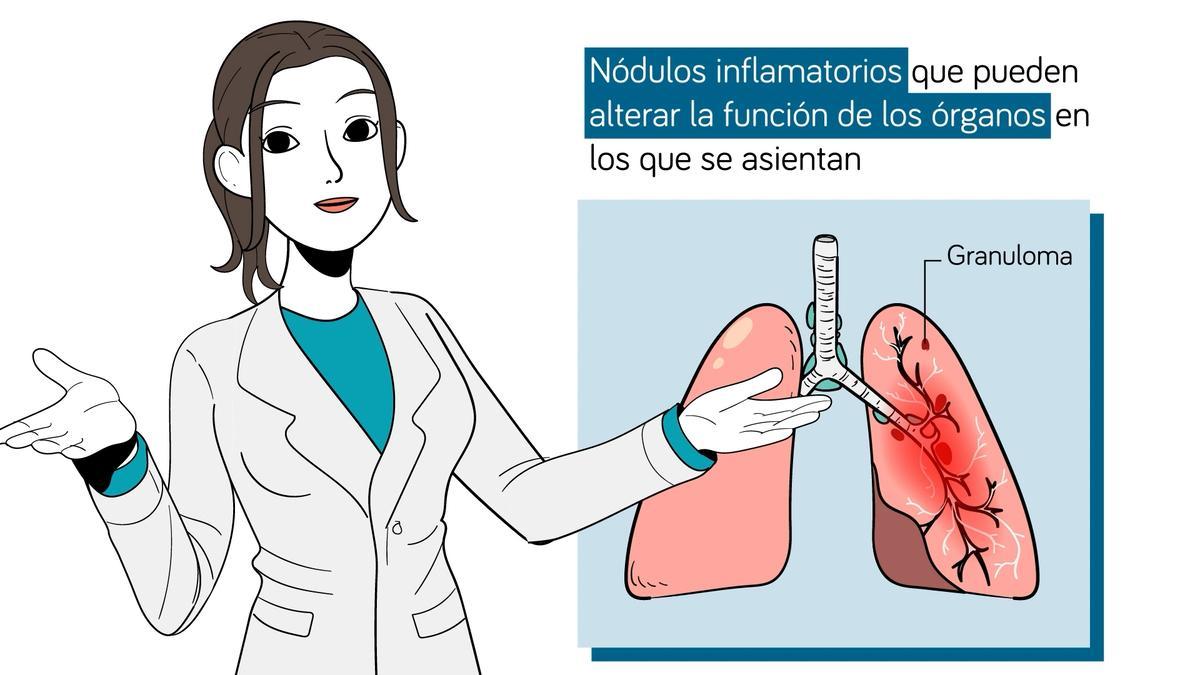 La identificación de los componentes genéticos de la sarcoidosis es uno de los principales retos que se plantean actualmente en el abordaje de esta enfermedad autoinmune sistémica de baja prevalencia