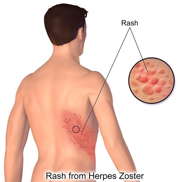 Herpes Zóster fotos | Estos son los síntomas del herpes zóster