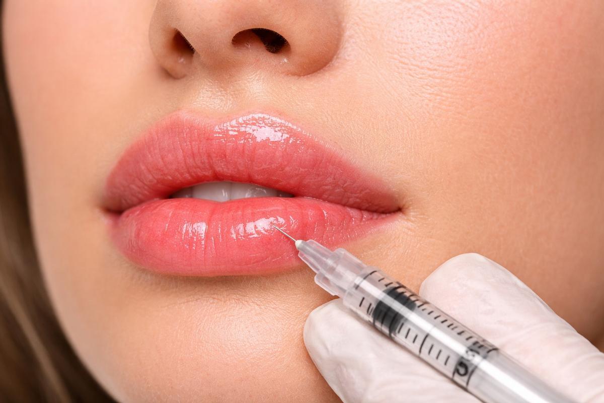 Imagen recreada de un tratamiento con ácido hialurónico en los labios.