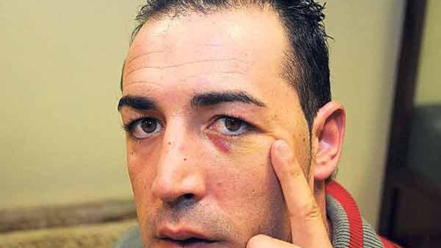 Isidoro Carabelos, sobrino de Manuel, muestra un hematoma.