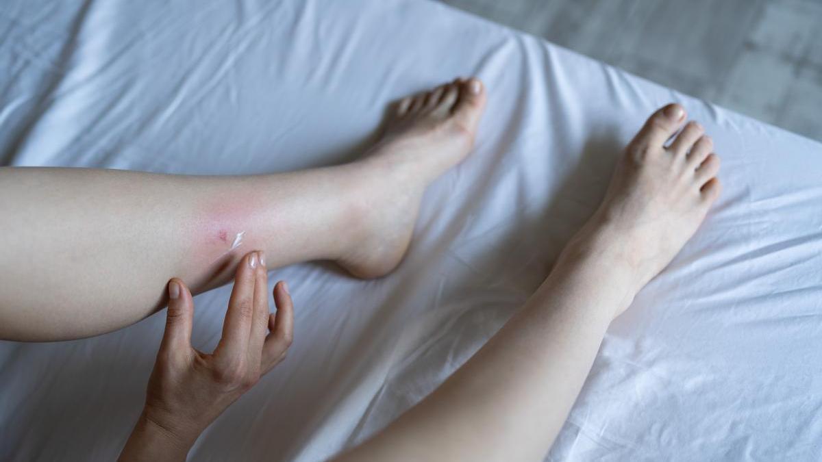 Cómo actuar ante una picadura de mosquito inflamada: lo que nunca debes hacer.