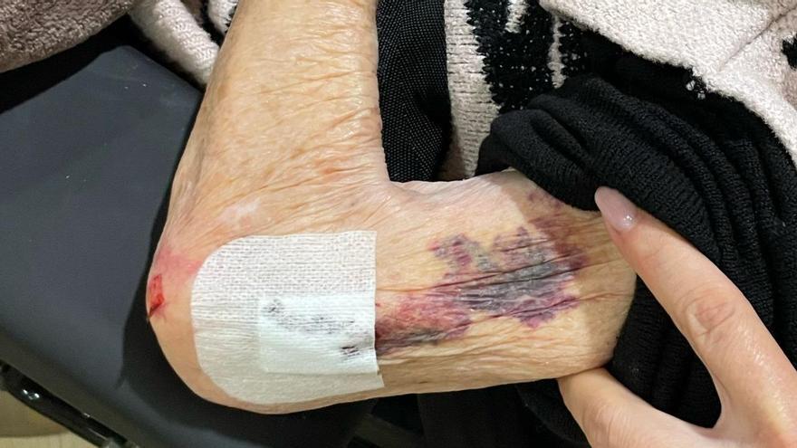 Lesiones que presentaba la anciana que está interna en la residencia de Marratxí.