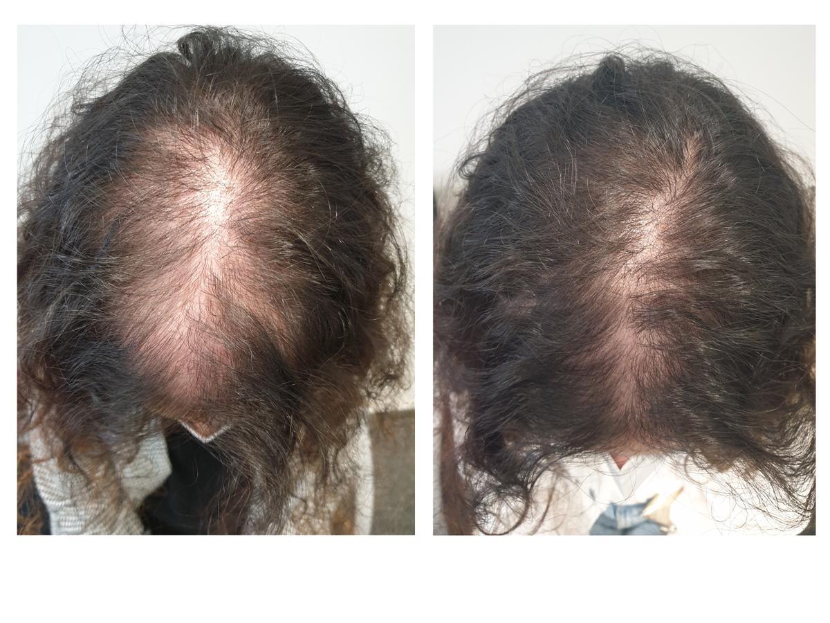 Resultados tras doce meses en una paciente con un tratamiento de 2 mg de minoxidil c/24h