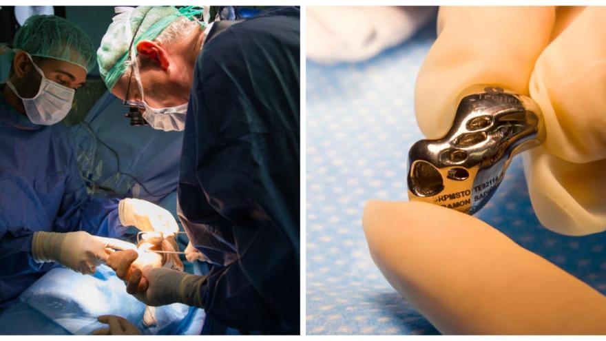 A la izquierda, el equipo médico del hospital de Alzira durante la operación. A la derecha, detalle del implante.