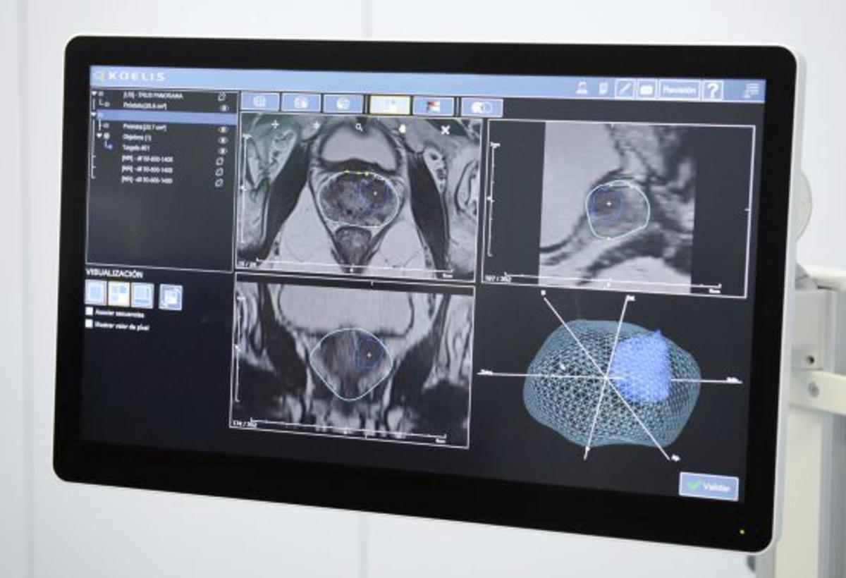 Prostatakrebs umfassend behandeln dank der Spezialisten der Clínica Rotger und des Hospital Quirónsalud Palmaplanas