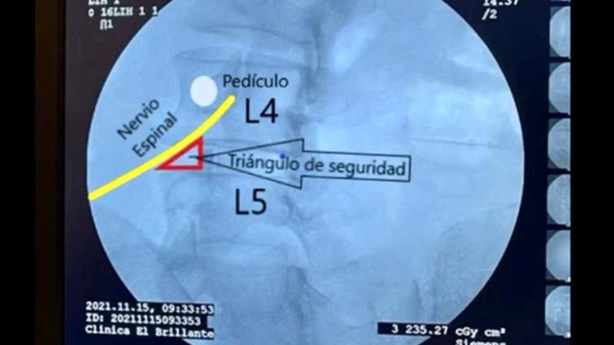 Imagen diagnóstico explicativa de una hernia discal