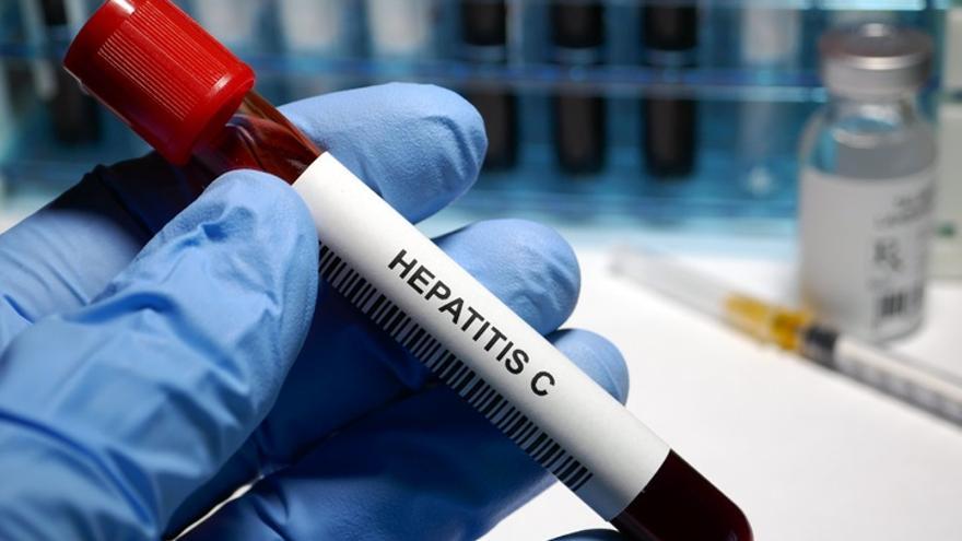 Hepatitis C.