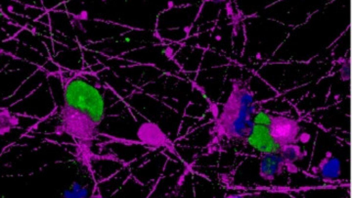 Imagen microscópica de neuronas motoras humanas cultivadas en laboratorio que portan una mutación de ELA, el tipo de célula que la enfermedad destruye.