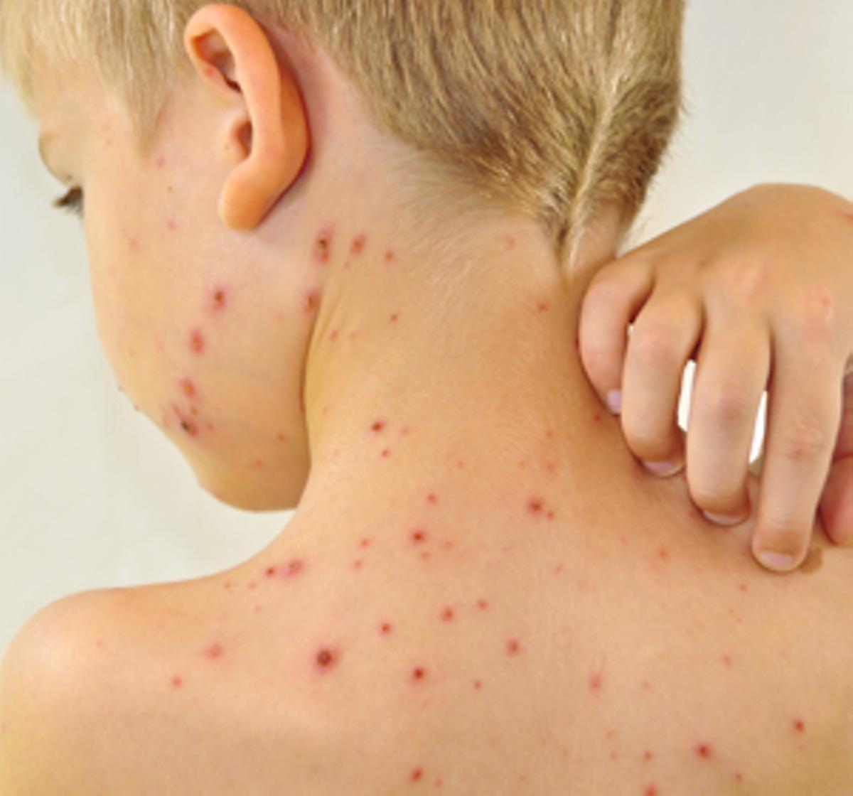 Varicela en niños: síntomas y tratamientos