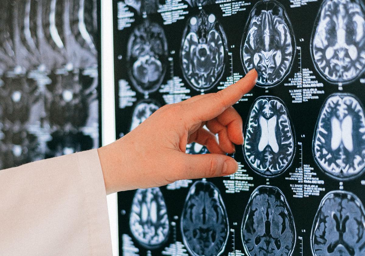 Un nuevo estudio encuentra que «algo cambia en el cerebro de quienes han sufrido COVID-19»