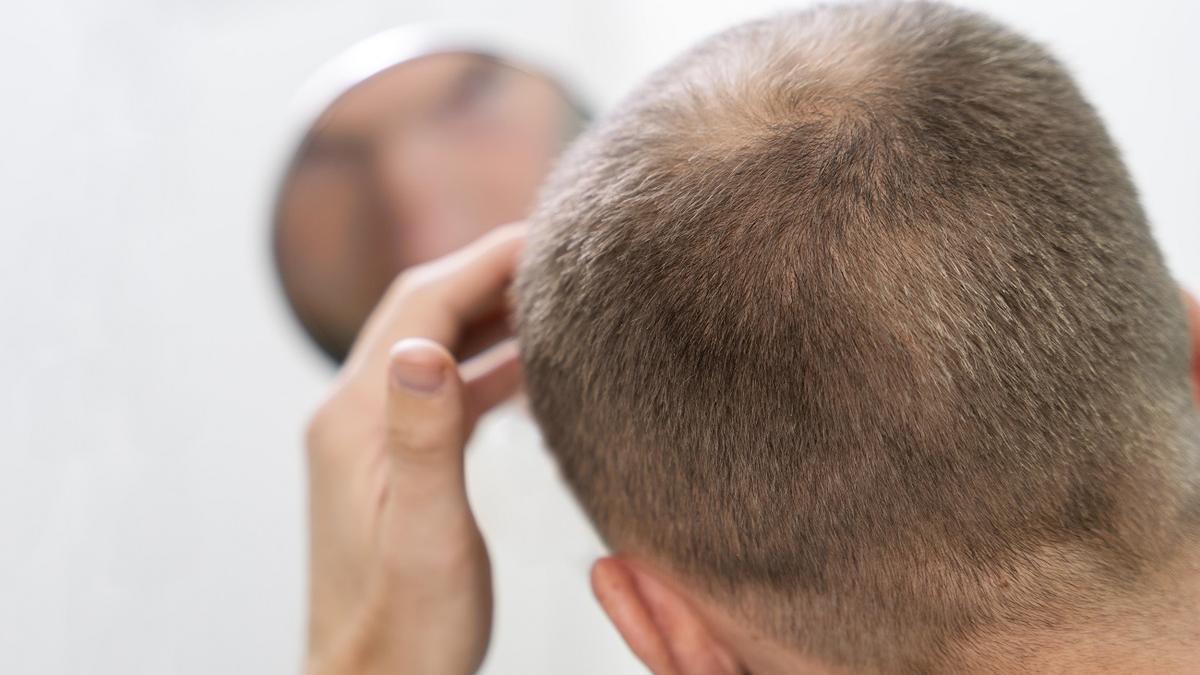 España es el segundo país con más casos de alopecia por habitante.