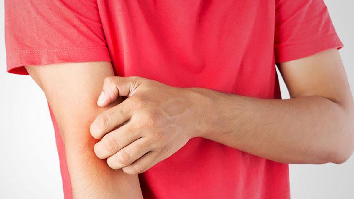 Eritema multiforme: fotos para aprender a reconocer este nuevo efecto secundario de la vacuna del covid.