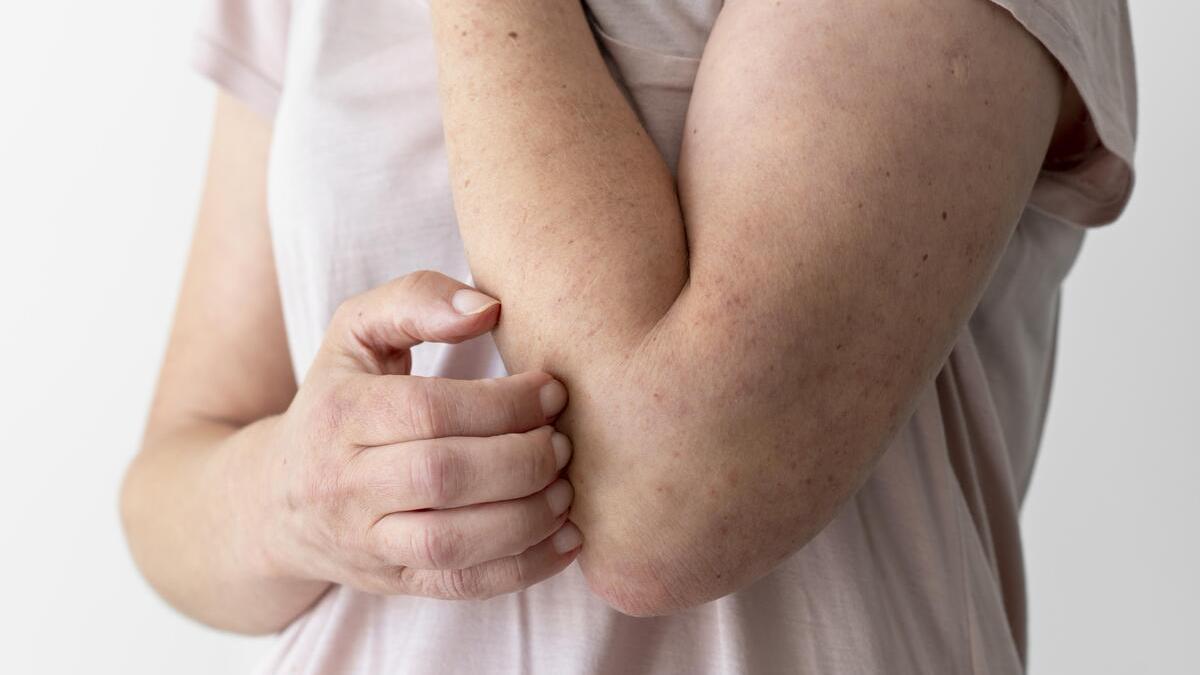 La miliaria es una afección cutánea que aparece en episodios de altas temperaturas