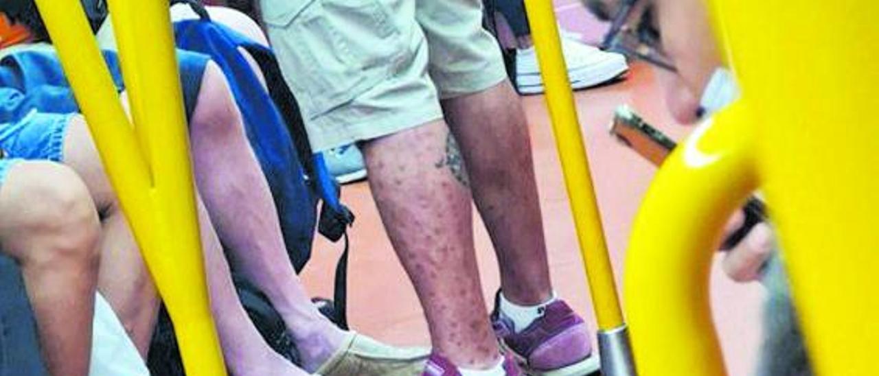 Lesiones de viruela del mono en la pierna de un usuario del metro de Madrid.