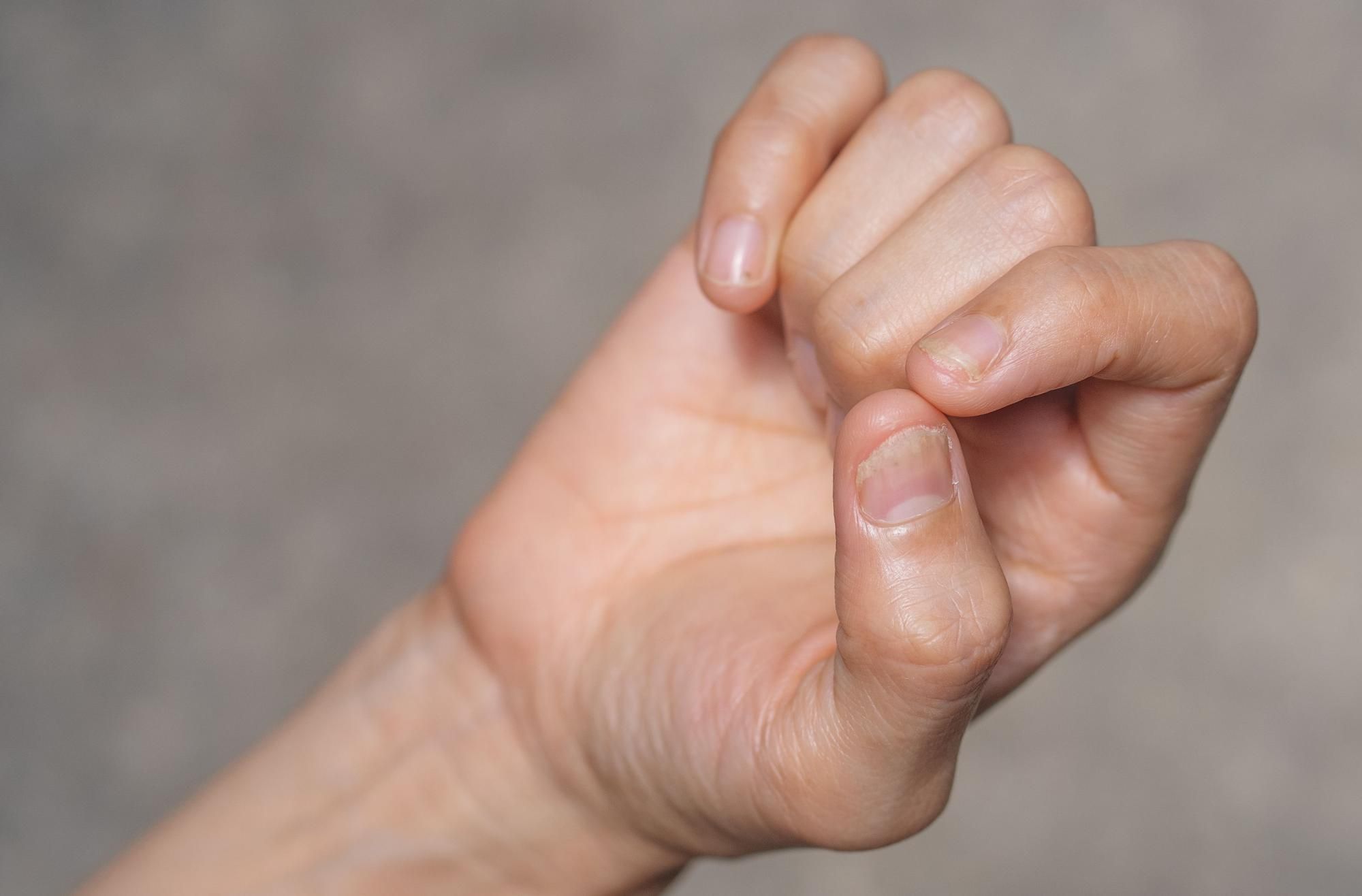 Cinco motivos por los que se te pueden caer las uñas.