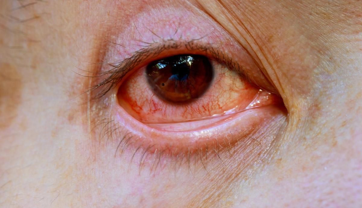 Uno de los síntomas de la leptospirosis es la conjuntivitis.