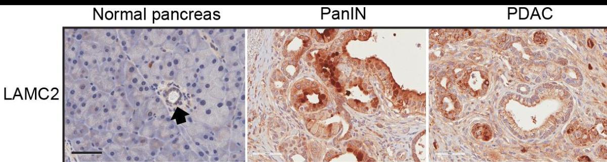 Imagen microscópica del gen LAMC2 (marrón) en tejido de páncreas normal; de tejido preneoplásico pancreático (PanIN) y en tejido tumoral de adenocarcinoma pancreático (PDAC).