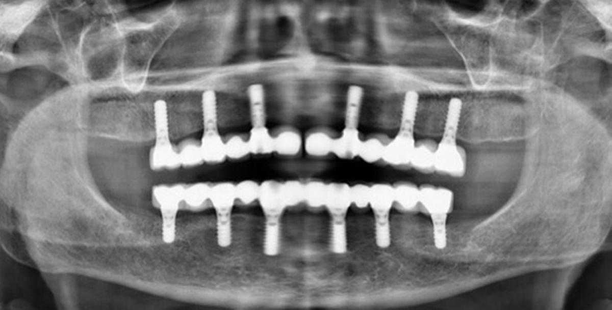 Tipos de implantes dentales y precios