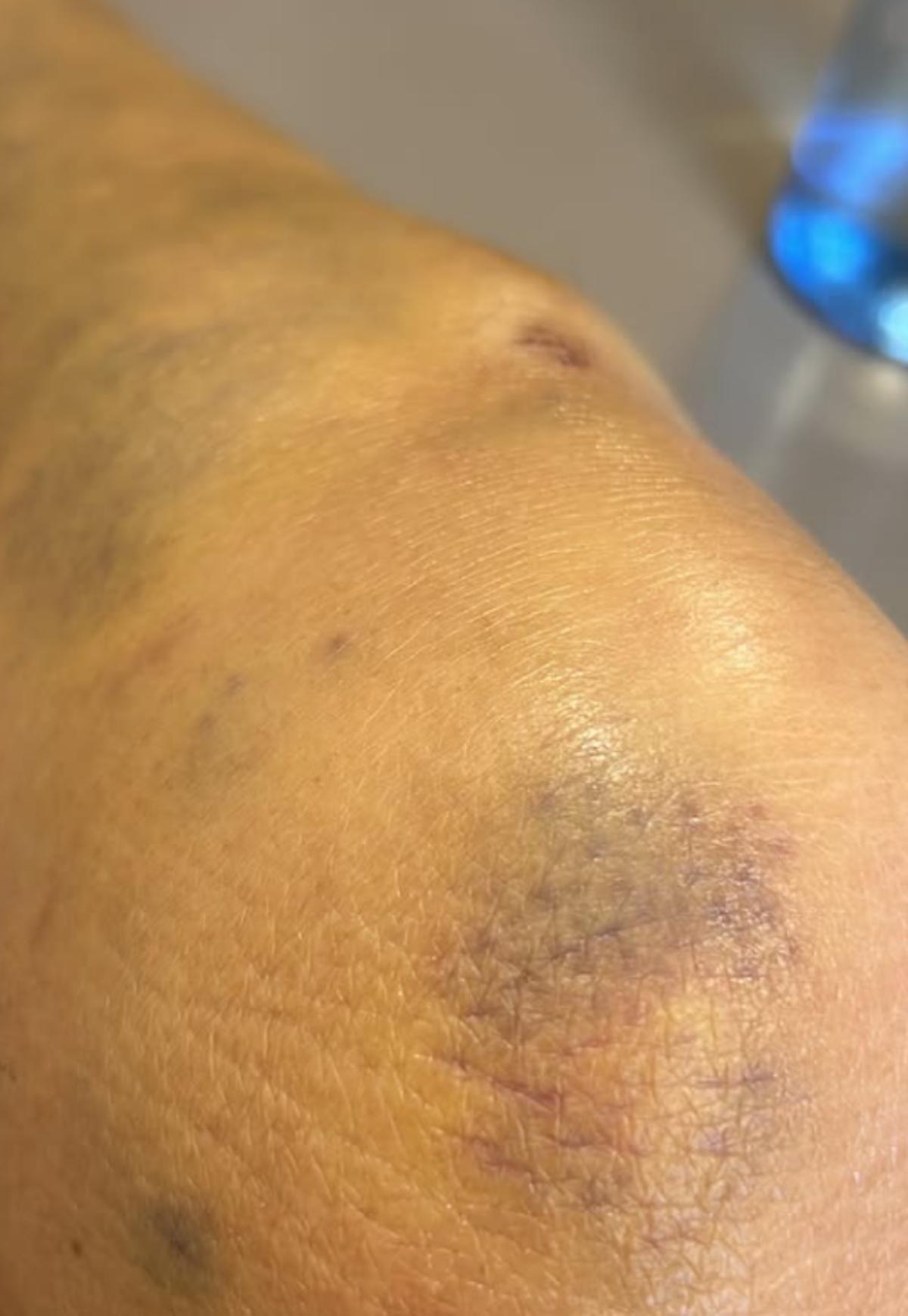 La tendinitis rotuliana que ha sufrido Lydia Bosch ensayando