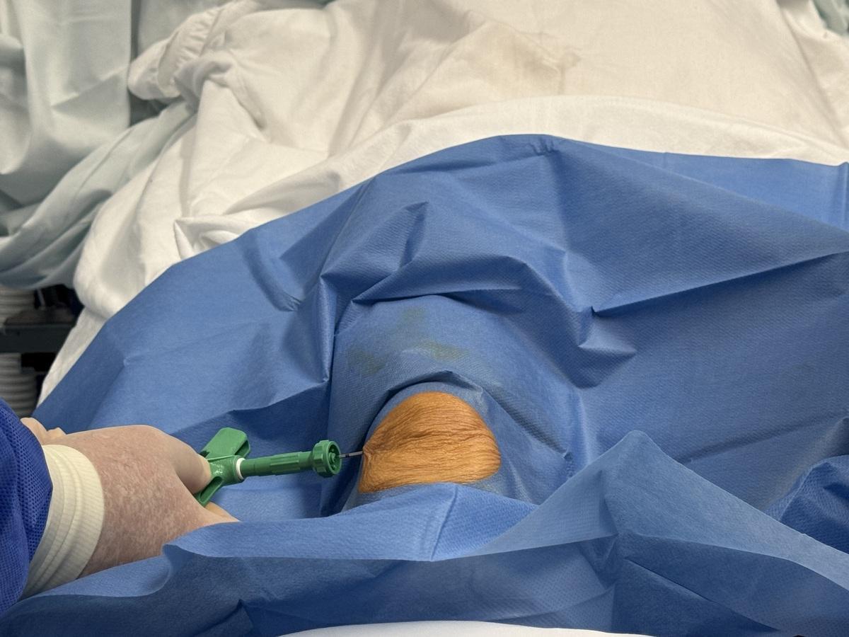 Momento de la inyección de las células madre en la rodilla con condropatía rotuliana.