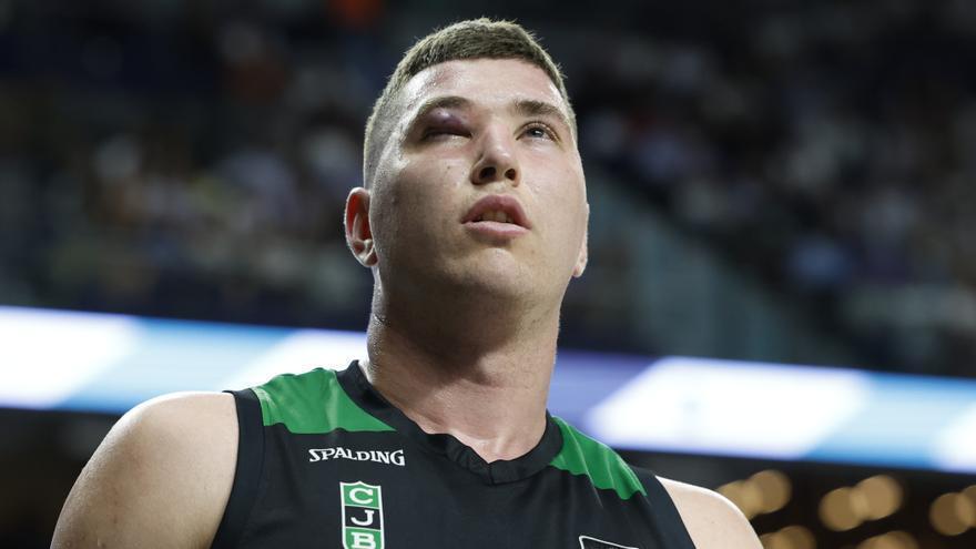 El rostro de Joel Parra, jugador del Joventut que sufrió en el primer partido un gran golpe en su ojo.