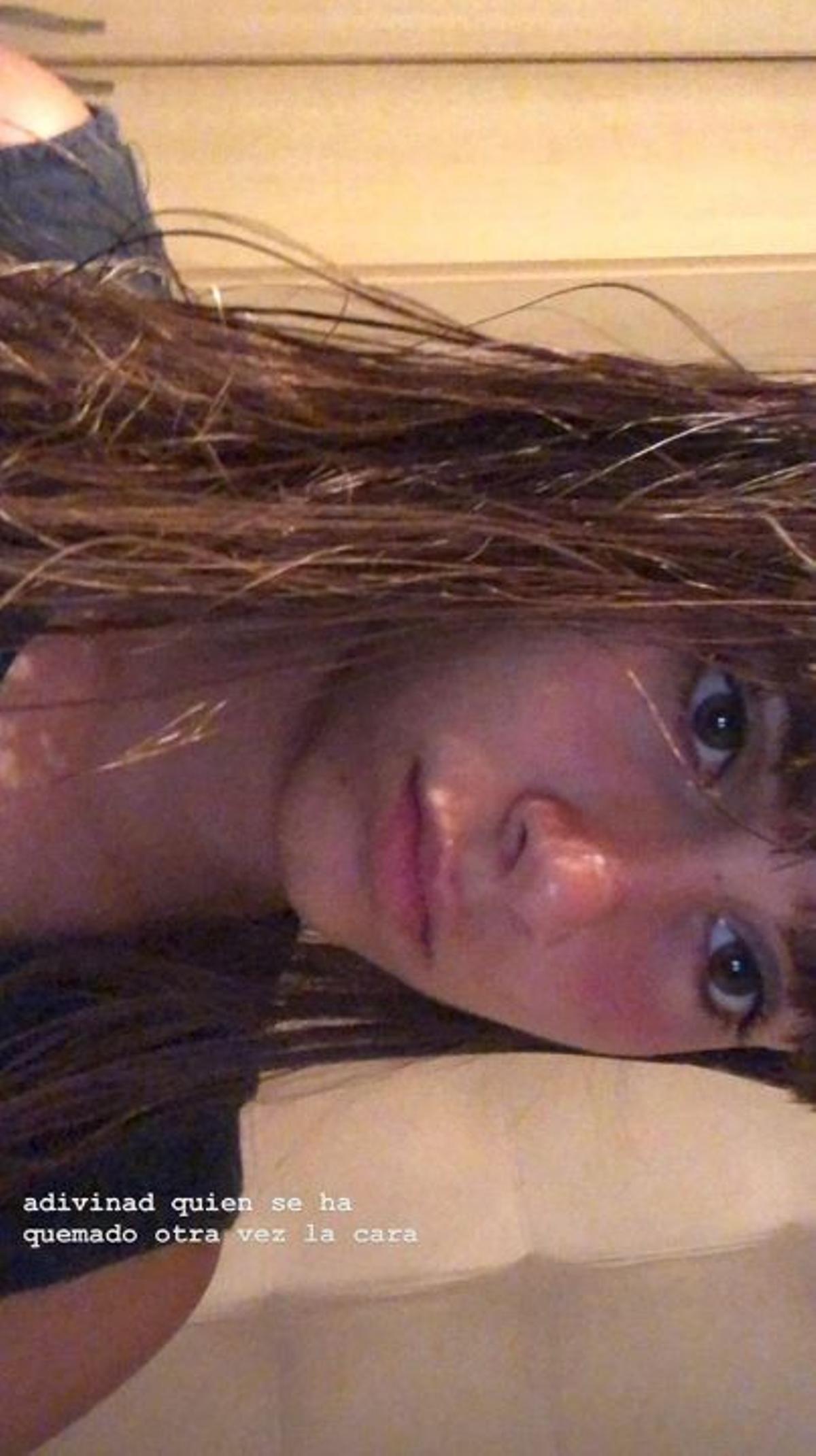 Aitana se quema la cara en la playa